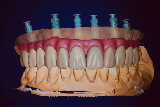 Full-arch implant-supported prosthetic restoration